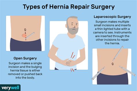 Effective Strategies for Managing and Treating Hernia