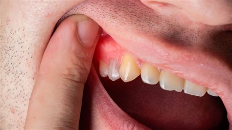 Effective Strategies for Treating and Preventing Swollen Teeth