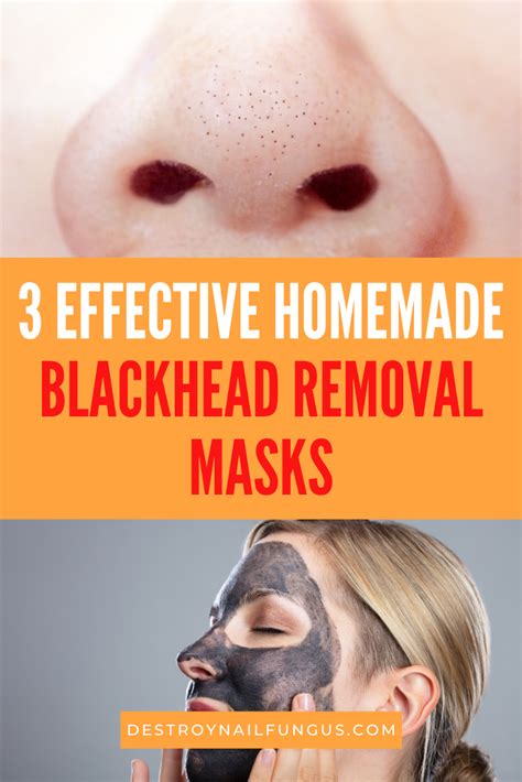 Effective Ways to Get Rid of Pesky Blackheads at Home