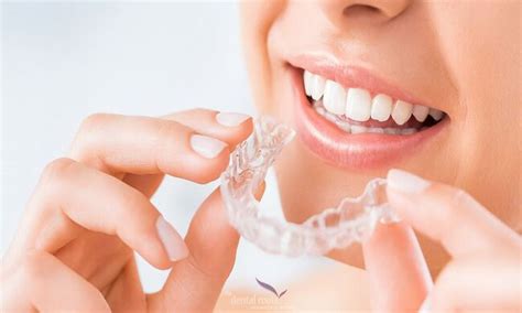 Embracing Braces: Embarking on a Transformational Journey towards a Flawless Smile