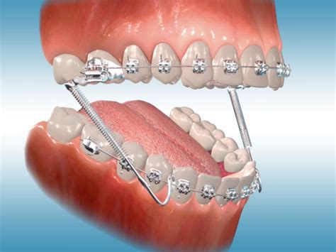 Emotions and Reactions Associated with Dreams of Orthodontic Apparatus Disengaging from Teeth