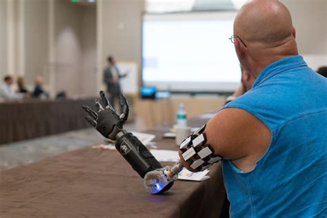 Empowering Amputees: Unlocking the Potential of Advanced Prostheses