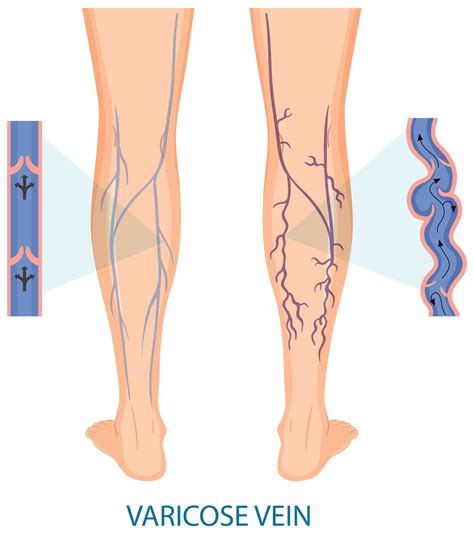 Empowering Yourself: Managing Spider Veins and Enhancing Self-Confidence