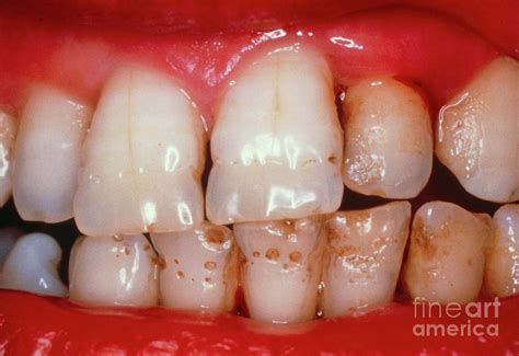 Enamel Hypoplasia: Exploring Defects in Tooth Enamel