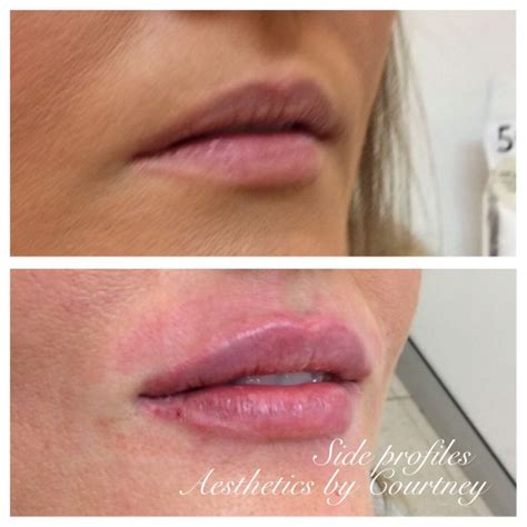 Enhancing Your Pout: The Growing Trend of Lip Injections