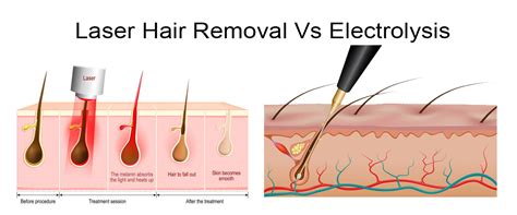 Evaluating Laser and Electrolysis Hair Removal