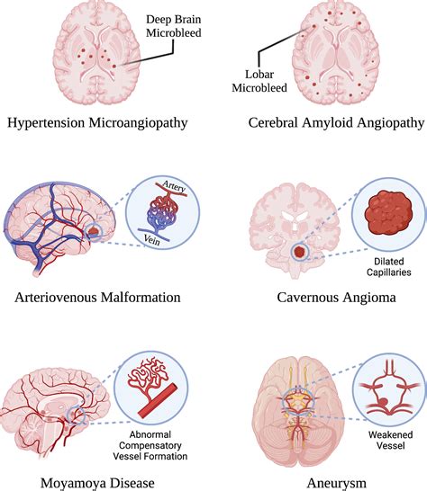 Evaluating the Manifestations of Intracranial Hemorrhage in Dreams