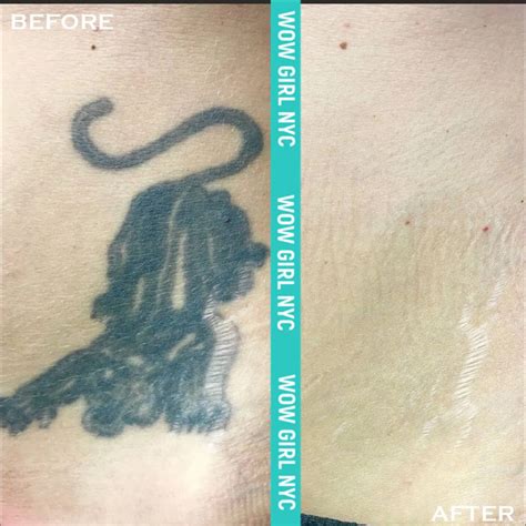 Examining the Advantages and Limitations of Laser Tattoo Removal