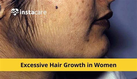 Examining the Psychological Impact of Excessive Hair Growth: Addressing Social Stigma