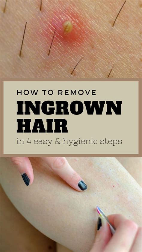 Expert Advice: Proper Techniques for Removing Ingrown Hair