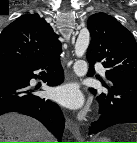 Exploring Coral Aorta's Impressive Height