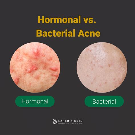 Exploring Different Types of Acne: From Hormonal Imbalances to Bacterial Infections