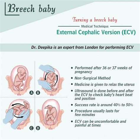 Exploring External Cephalic Version (ECV) as an Intervention for Babies in Breech Presentation