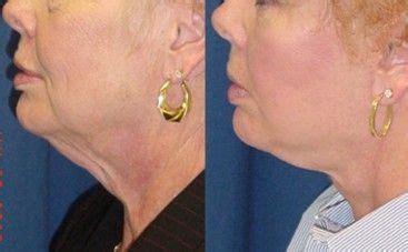 Exploring Facial Transformation: A Comprehensive Overview of Techniques in Facial Surgery