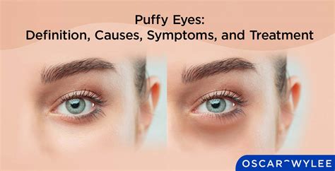 Exploring Medical Options for Treating Severe Under Eye Puffiness