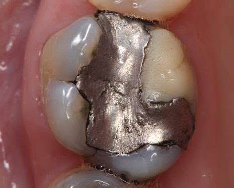 Exploring Shattered Molar Teeth as a Reflection of Inner Strength and Stability