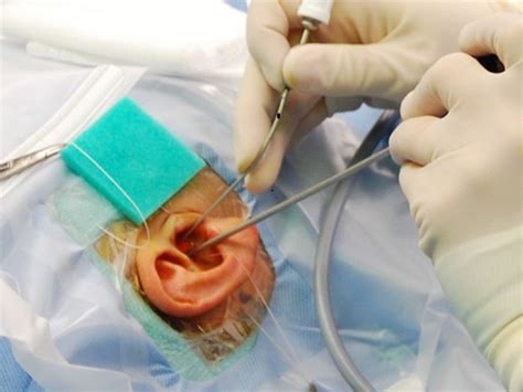 Exploring Solutions: Surgical Options for Persistent Ear Blockage