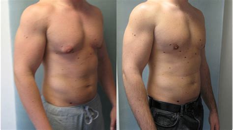 Exploring Solutions: Surgical and Non-surgical Options for Resolving Male Breast Enlargement