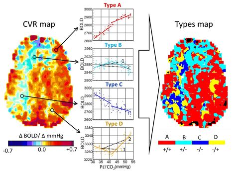 Exploring Techniques to Analyze and Interpret Dreams of Cerebrovascular Incidents for Personal Growth