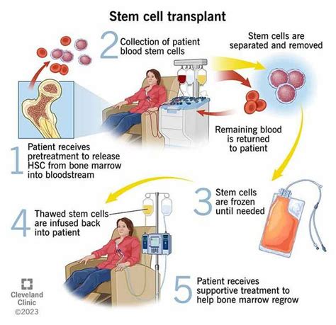 Exploring Treatment Options for Blood Cancer: From Chemotherapy to Stem Cell Transplant