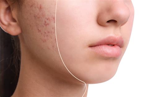 Exploring Treatment Options for Severe Acne