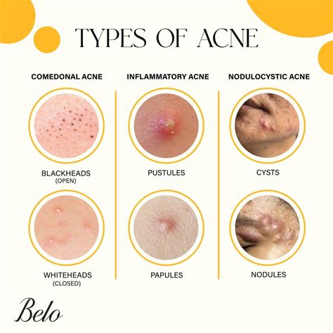 Exploring Various Forms of Acne