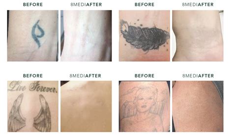 Exploring Various Methods for Erasing Tattoos