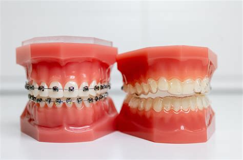 Exploring Various Treatment Options for Correcting Dental Alignment