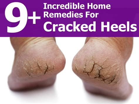 Exploring professional treatments for severe cracked heels