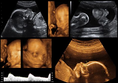 Exploring the Astonishing Details Visible in Sonogram Scans