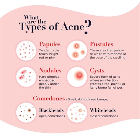 Exploring the Causes and Varieties of Acne