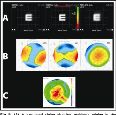 Exploring the Depths: Enhancing the Understanding of Dark Ocular Spheres