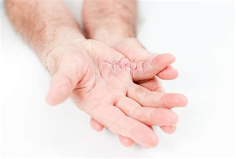 Exploring the Emotional and Psychological Importance of Scars on the Hands