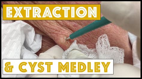 Exploring the Fascination: Unraveling the Intrigue Behind Dreams about Cyst Extraction