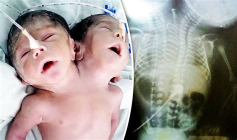 Exploring the Fascination with Dual-Headed Infants