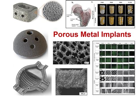 Exploring the Intricacies of Metal Implants in the Field of Medical Science