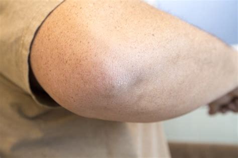 Exploring the Potential Causes of Rough and Dark Elbows