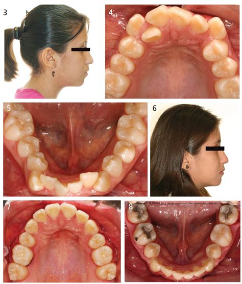 Exploring the Power of Lucid Dreams: Influencing the Outcome of Dental Extractions