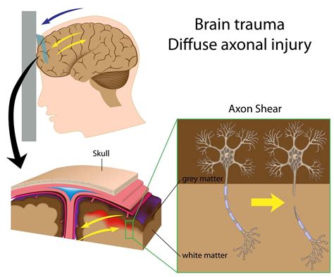 Exploring the Psychological Associations of Head Injuries