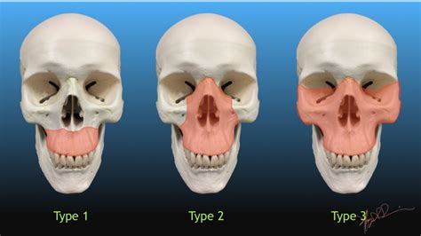 Exploring the Psychological Significance of Facial Fractures