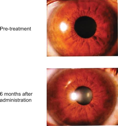 Exploring the Science behind Iris Pigmentation