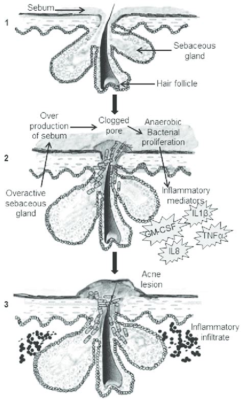 Exploring the Scientific Basis of Acne Development