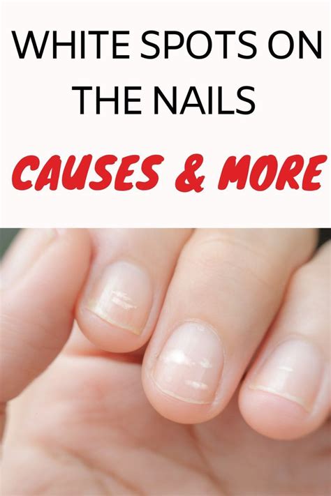 Exploring the Significance of Grubby Nails as Indicators of Neglect