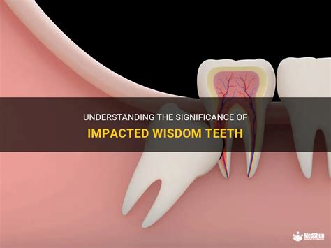 Exploring the Significance of Wisdom Teeth