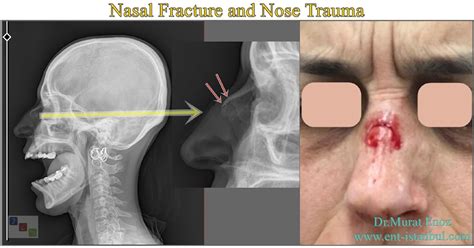 Exploring the Symbolic Meaning of a Fractured Nasal Bridge in Dreams