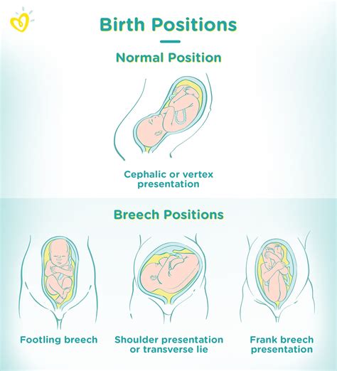 Exploring the Symbolic Significance of Dreams Depicting the Birth of a Breech Infant