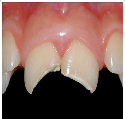 Exploring the Symbolic Significance of Fractured Enamel in Oneiric Explorations