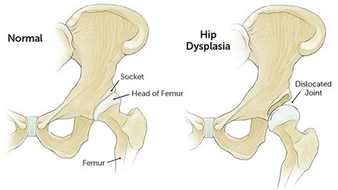 Exploring the Underlying Triggers of Hip Dislocation