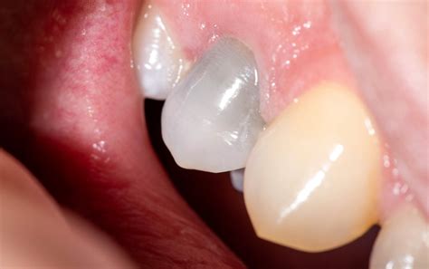 Exploring the Wisdom of Professional Insights for Mysterious Darkened Teeth in Dreams