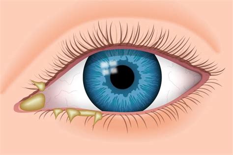 External Factors that Contribute to Eye Discharge